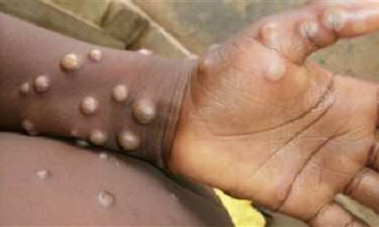 Three more cases of monkeypox found in UAE