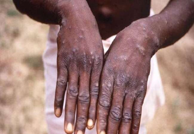 After Corona, now a case of monkeypox virus found in Britain, know what are the symptoms